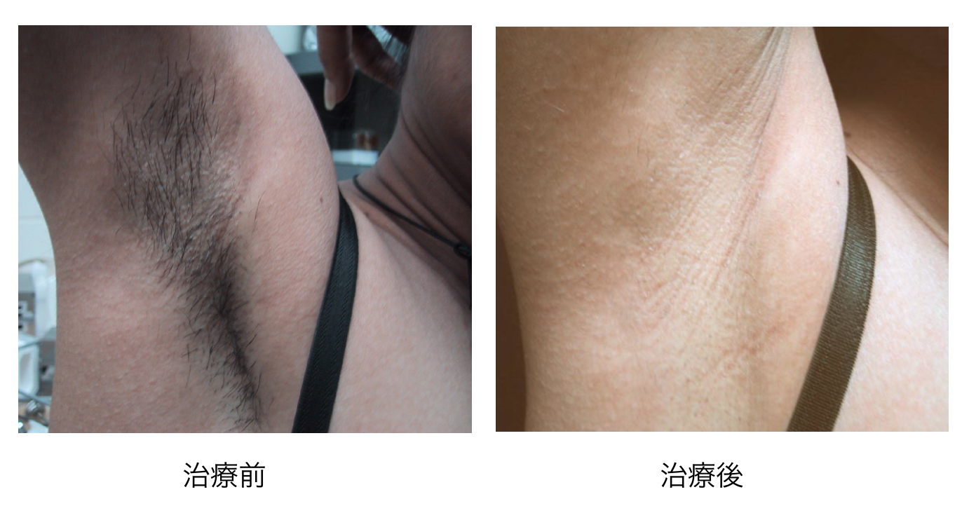 医療用レーザー脱毛効果