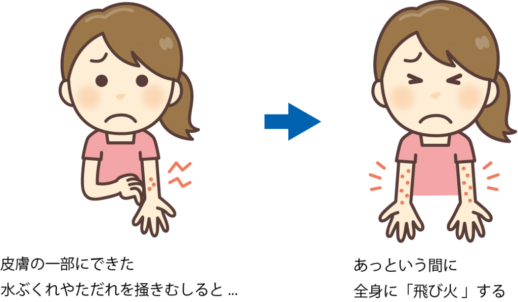とびひ