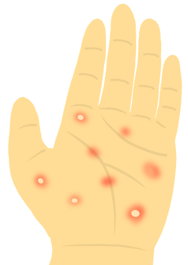 掌蹠膿疱症