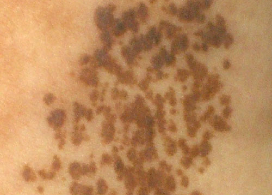 アザ 鶴町皮膚科クリニック 茨城県土浦 つくば市の美容皮膚科 一般皮膚科 小児皮膚科