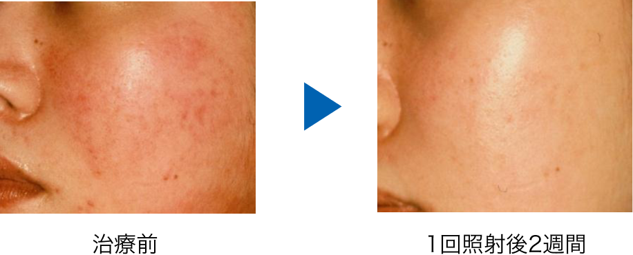 色素レーザー Vビーム 鶴町皮膚科クリニック 茨城県土浦 つくば市の美容皮膚科 一般皮膚科 小児皮膚科