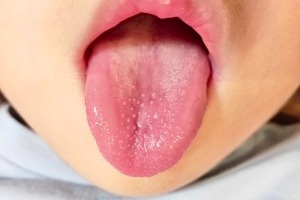 川崎病