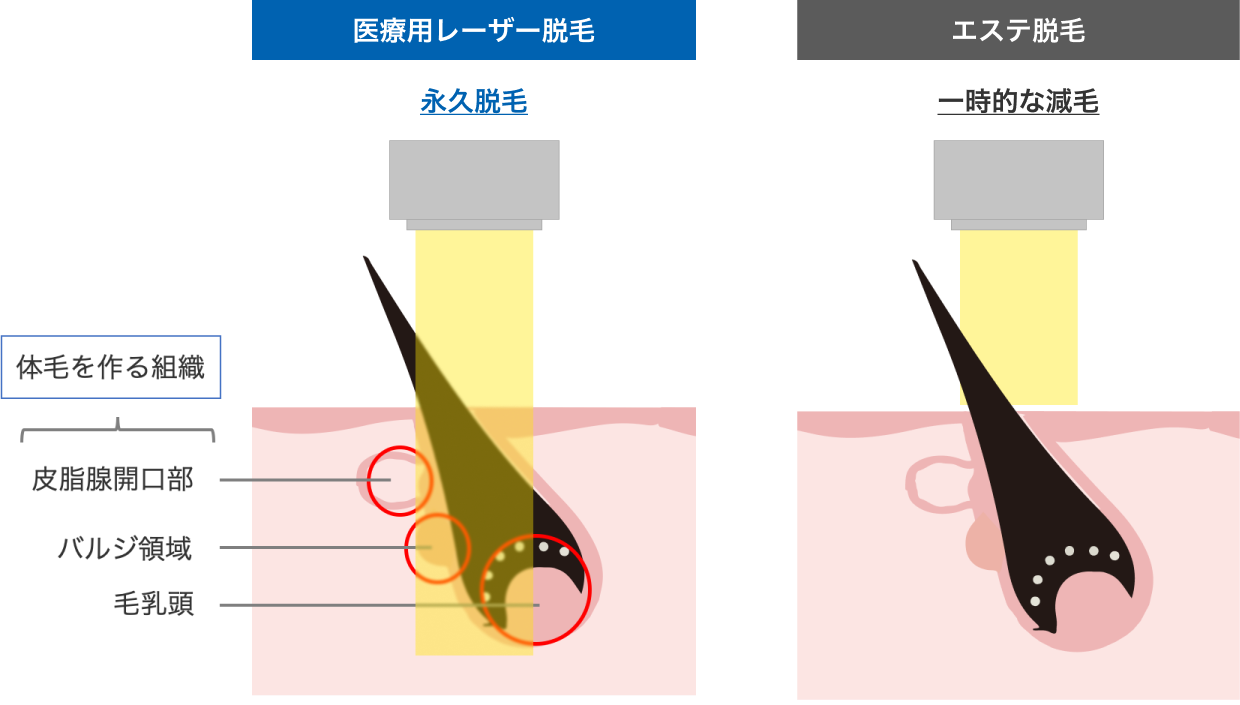 医療脱毛とエステ脱毛の違い